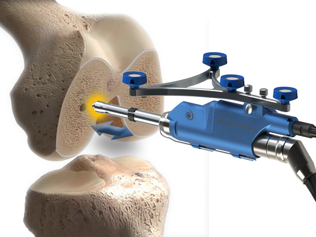 Eerste Knieprothese Met Behulp Van Een Robot In UZ Gent Zorg Magazine